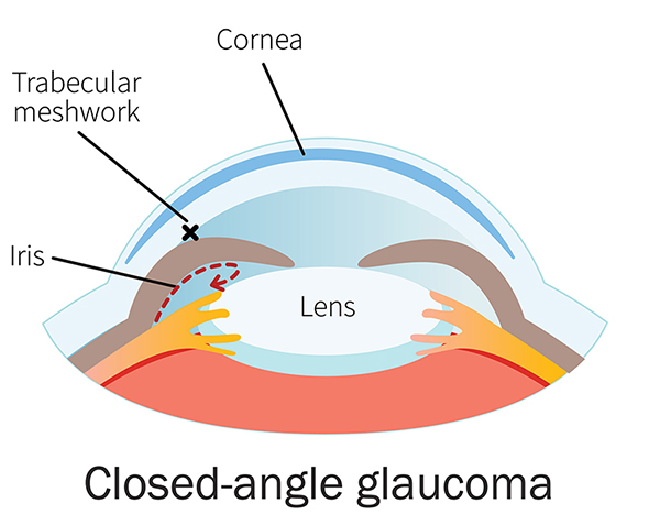Chart showing how closed-angle glaucoma affects an eye
